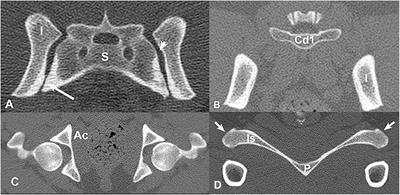 A sacroiliac ízületi tünetei. Keresztcsonttáji fájdalmak - Dr. ORMOS GÁBOR PhD